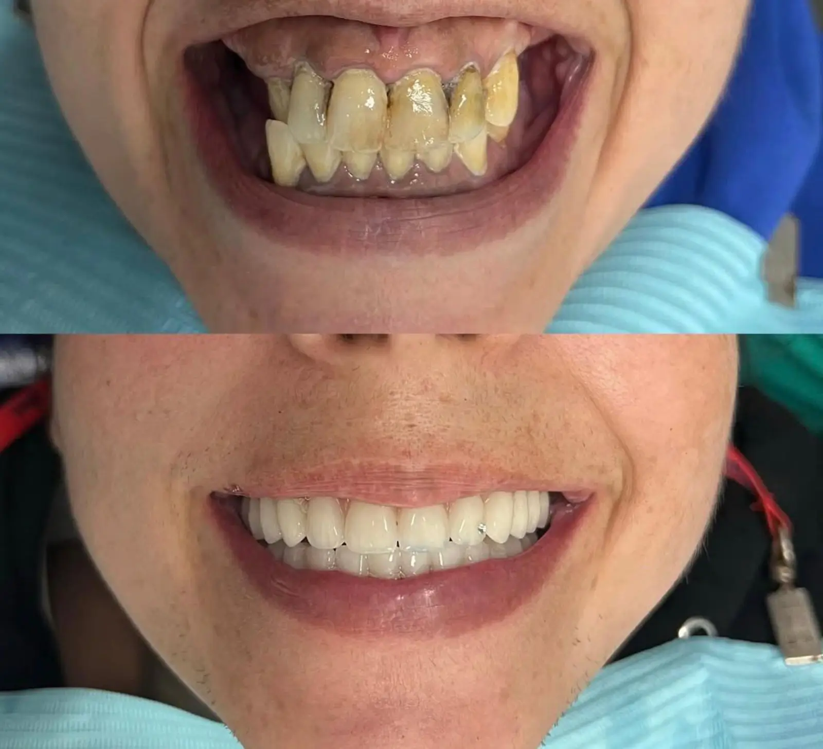 Antes e Depois - 5 (2)