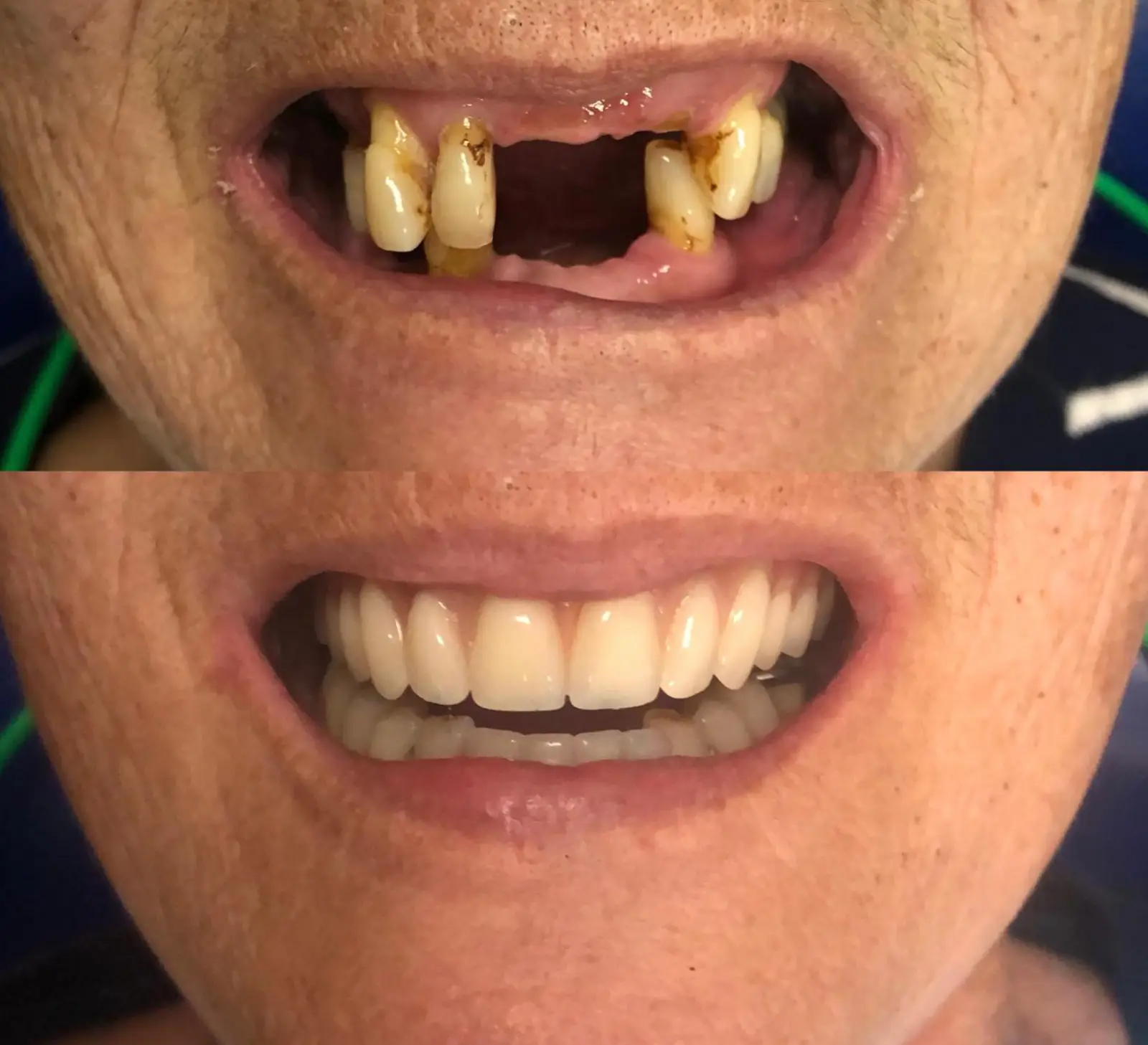 Antes e Depois - 5 (4)